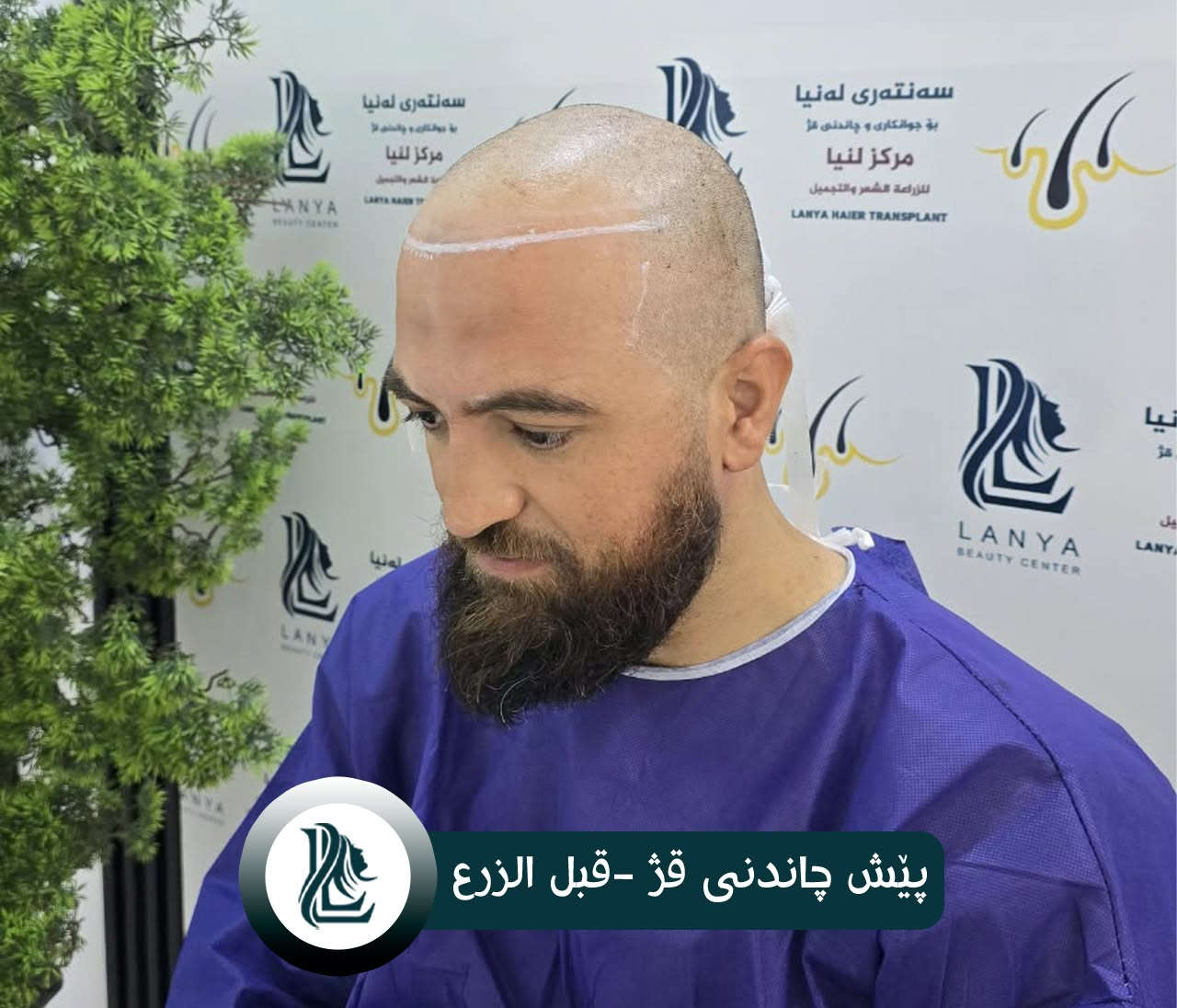 زراعة شعر • لەنیا • كلار