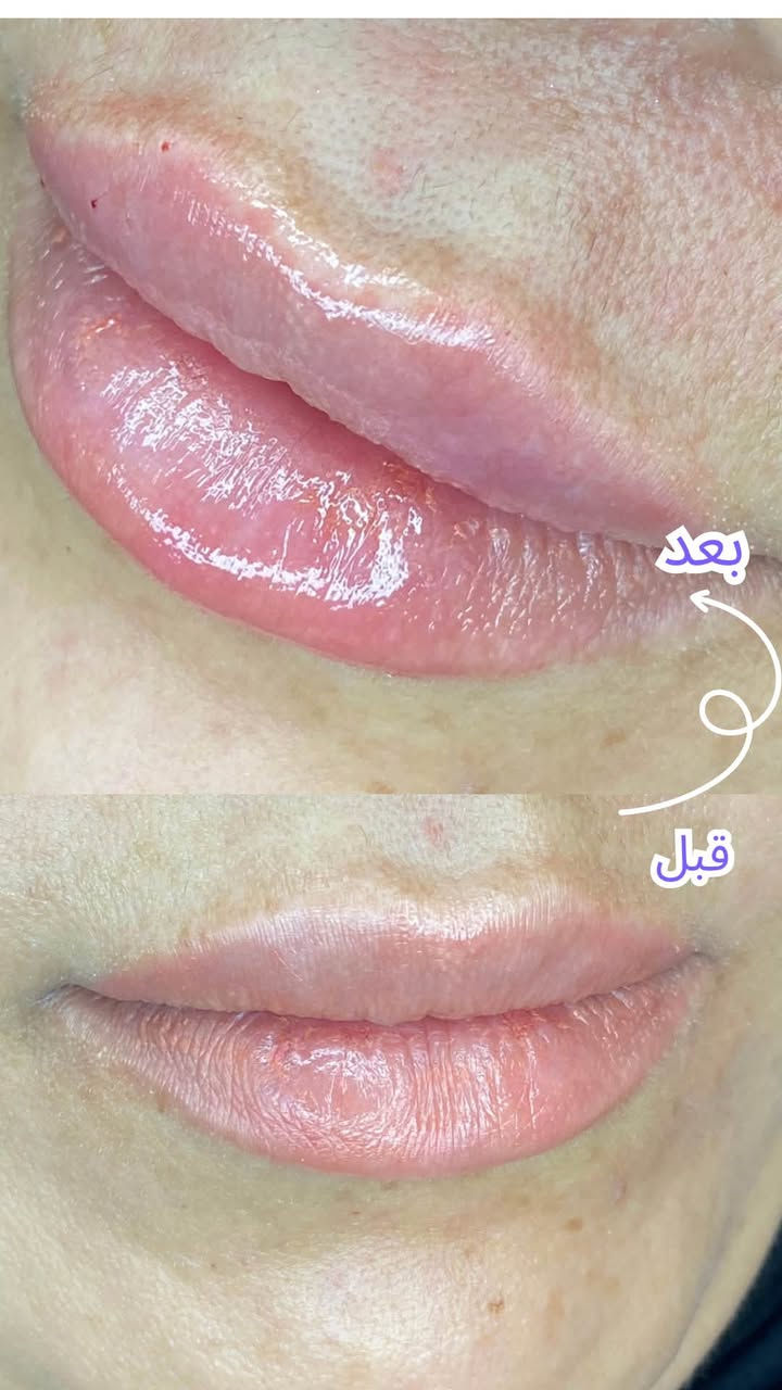زيركون بسماية
نظام التقسيط يشمل جميع الاقسام وبدون مقدمة

والفحص مجانا 🥰

✨ جمالكِ مُهمتنا…..
شفايف منحوتة بعناية… امتلاء ناعم بدون مبالغة 💋
نتيجة طبيعية تخلي الكل يلاحظ بدون ما يعرف السر .

الدكتورة زهراء نجاح الحسيني حاصلة على سرتفكيت في تجميل الوجه اللاجراحي

علماً ان جميع المواد المستخدمة من براندات ووكالات عالمية ومرخصة من وزارة الصحة العراقية
———————————————————
بغداد-مقابل باب مجمع بسماية الالكتروني B الخدمي الراجع من بغداد عمارة كافي حنوش
مجاور صيدلية مريم عامر 

  للحجز+اسفسار
0775746377

#بسماية #تجميل #فلر

نص مكتوب في الصور:
- شكل شفة غير متناسق عدلنه التناسق وضفنه حجم حلو للمراجعة وطلعت باحلى صورة 🥰❤️
- بنات وفرتلكم احدث فلر كوري امتياز بعالم التجميل يبقى طري وينطي احلى رسمة ممكن تحصولها سعر العرض ب90 الف فقط 🔥❤️
- بعد قبل
- رسمة جديدة مكبوسة وحجم حلو حسب ذوق المراجعة الحلوة❤️
- لعناية وتجميل الأسنان