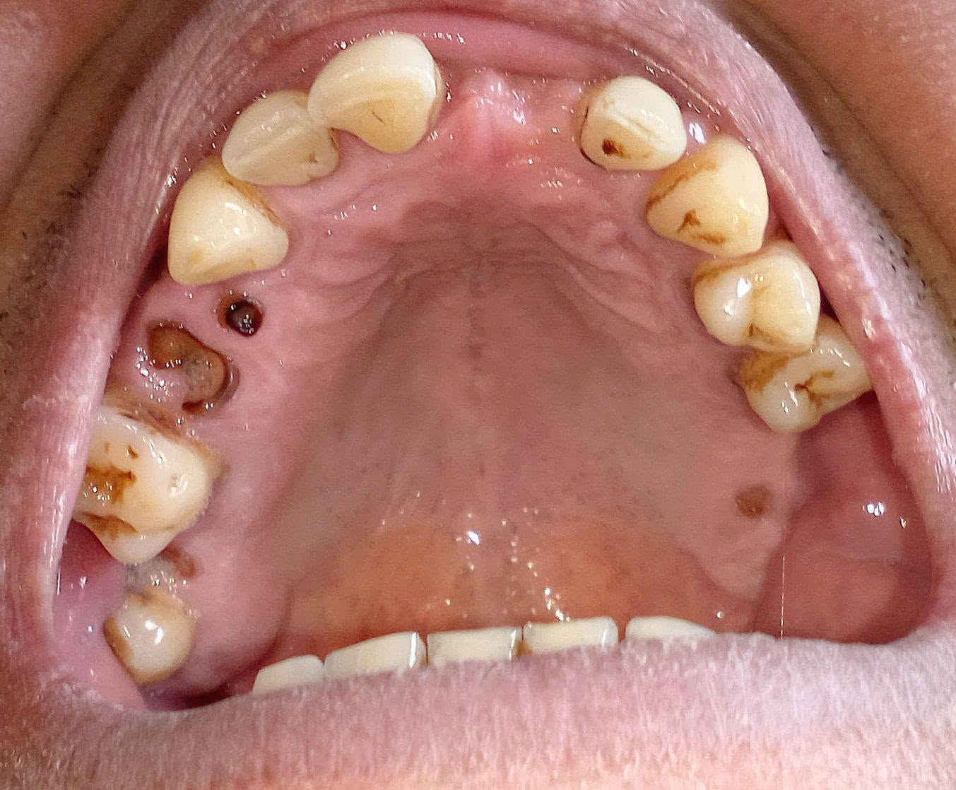 بسم الله الرحمن الرحيم
يعلن مستشفى جامعة البيان التعليمي فتح ابابه لاستقبال الحالات المرضية الخاصة بطب الاسنان التي تشمل :- 
اولا العلاج المجاني🟩🟩🟩 :-
1- قلع و ازالة الجذور التالفة و الاسنان المتداعية 
2- الحشوات الضوئية و حشوات الجذور
3- تنظيف الاسنان العميق 
4- اطقم متحركة كاملة و جزئية
5- تقويم الاسنان المتحرك
6- علاج الاطفال و الاسنان اللبنية بكافة حالاتها 
ثانيا العلاج المدفوع🟥🟥 :-
1-  عمليات جراحة اللثة الصغرى 
2 - زراعة الاسنان 
علما ان اغلب الحالات المذكورة في الاعلى يكون علاجها مجاني الا الزراعة و عمليات اللثة الصغرى تكون باسعار رمزية جدا
علما ان العلاج يكون تحت اشراف دكاترة مختصين 

للحجز و الاستفسار التواصل على الرقم :- ***********

