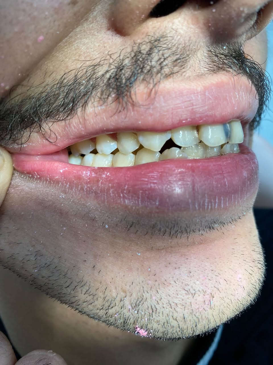 متوفر تنظيف اسنان يوم الاثنين بجامعة البيان الساعة 12:30 والتنظيف مجاني الي يحب يستفسر اكثر يتواصل على الخاص او واتساب ***********
