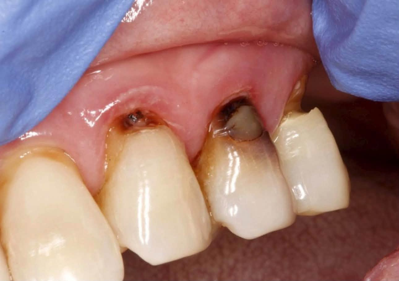 علاج مجاني بالكامل ‼️
لحالات التسوس بالحشوات التجميلية
قلع الجذور التالفة
تنظيف الاسنان من التكلسات و التصبغات 
تعويض الاسنان المفقودة بطقم متحرك 
العنوان: 
عيادات جامعة الهادي/ نهاية شارع 60
التواصل على الرقم 
***********
