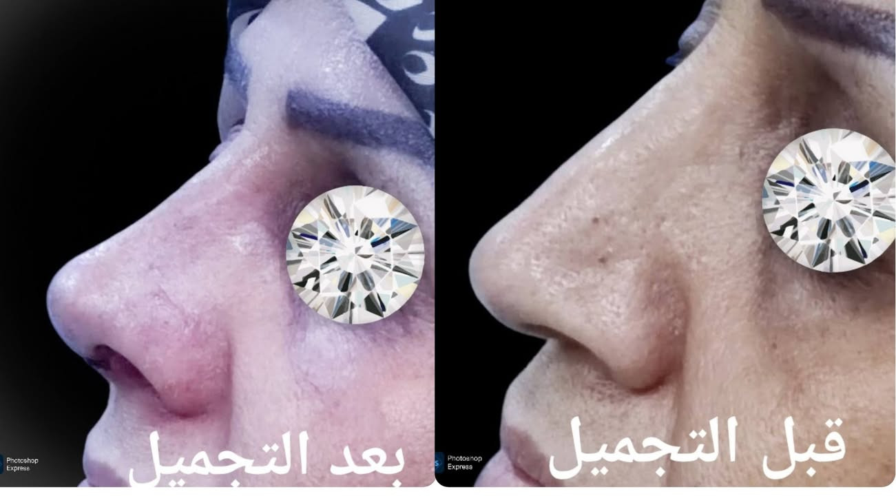 بعد رفع القالب مباشره... تجميل الانف الطبيعي
        ***********

نص مكتوب في الصور:
- قبل التجميل بعد التجميل
- بعد التجميل
- قبل التجميل
- بعد رفع القالب مباشره