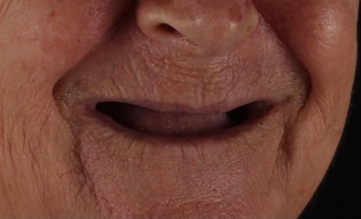 الرمادي • طقم اسنان متحرك • جامعة المعارف
