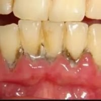 ⭕️ تنظيف اسنان مجاني بجهاز السكيلر للحالات التالية: للاستسفار والحجز ع...