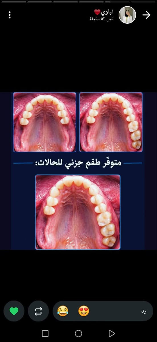علاج الأسنان بشكل مجاني
وبإشراف أطباء إختصاص للي محتاج أي من الحالات التالية :
حشوات ضوئية (بيضه )
قلع الأسنان التالفة و الجذور
طقم جزئي متحرك
تنظيف الأسنان ( للي عنده تكلسات)

لحجز موعد التواصل مع الحساب 
تلواصل
 فيس Rana Ahmed
@dr_rana_dentalانستا 
تلي @Rayoun55
***********

نص مكتوب في الصور:
- قلع الأسنان التالفة والجذور المتبقية
- أزالة التكلسات والترسبات وتنظيف الاسنان " Dr Lobna K.
- هاي الحالات الي نستقبلها ب عيادات الجامعة  👇 الحشوات الضوئية والتجميلية أستقبل كل حالات التسوس الموضحة بالصور "
- نباوي❤️
- قبل ٥٣ دقيقة
- متوفر طقم جزئي للحالات: