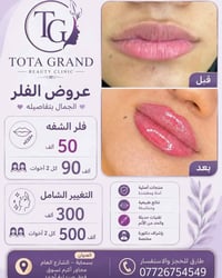 توته كراند • فيلر شفايف • اخصائي جلدية