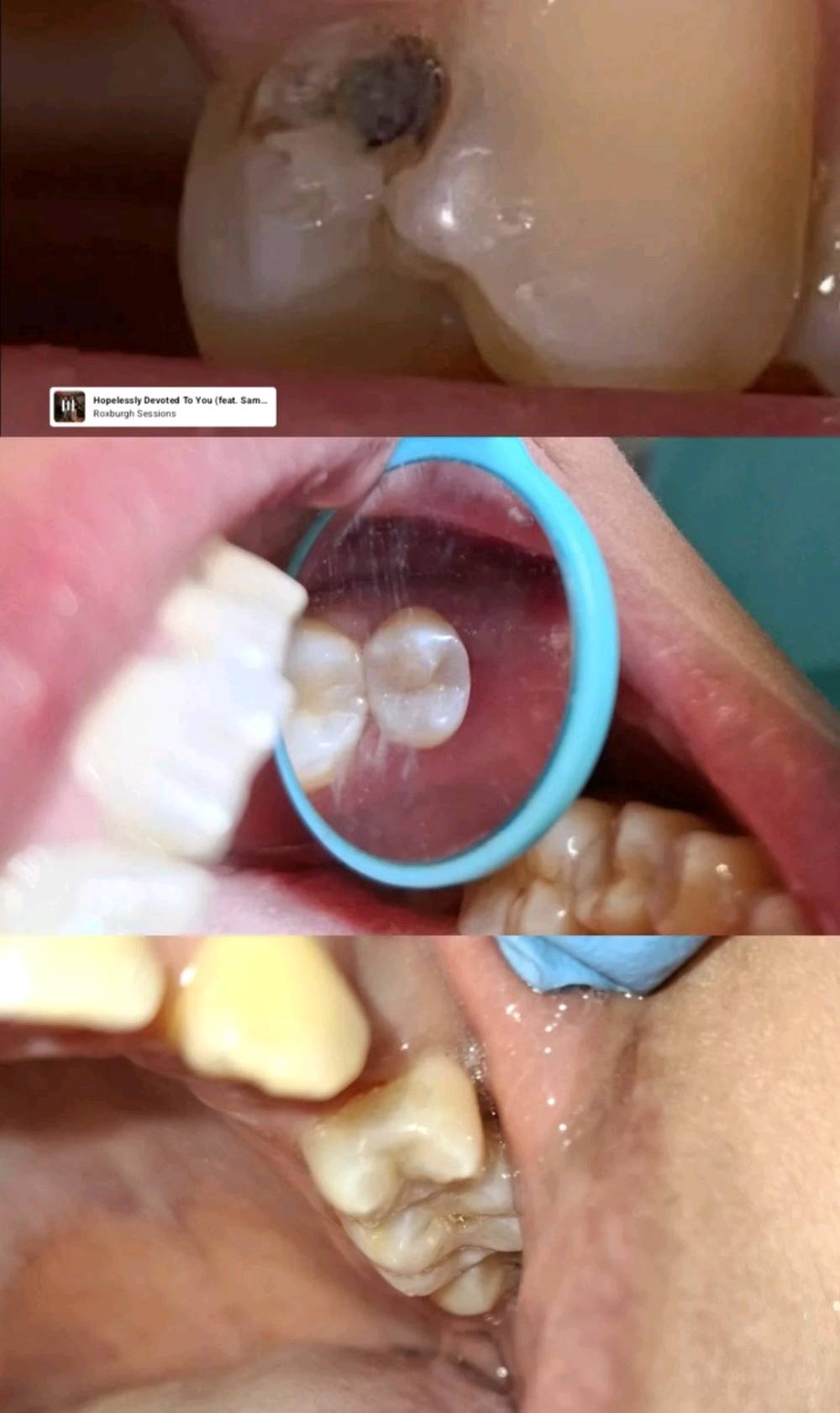 عيادة رينيو تقدملكم افضل الحشوات العلاجية والتجميلية والتبييض بالليزر وتنظيف وازالة التكلسات والتصبغات 
وعلاج البشرة من حقن علاجي وتجميلي 
العنوان مدينة الصدر ق 14 سوق الحي صورة السيد 
للحجز : ***********
ممكن تكتبون شنو أنواع الحشوات اللي متوفرة بالعيادة بالضبط، وهل تستخدمون مواد تجميلية اسمها/نوعها معروف؟: 
حشوات توكايما اليابانية 
حشوات ضوئية تجميلية وحسب الحالة باسعار من ٣٥ لحد ٦٥
شنو أوقات الدوام اليومية عندكم، وهل الحجز يكون بنفس اليوم لو لازم موعد مسبق؟: 
طيلة ايام الاسبوع صبح وعصر  عدا الجمعة
ممكن توضحون هل الفحص الأولي أو الاستشارة مجانية، وكم تقريباً أسعار الحشوات والتنظيف والتبييض؟: 
الفحص الاول والاستشارة مجانية 
منو الدكتور/الدكتورة المسؤول/ة عن العلاج، وهل عندكم اختصاصي أسنان أو تجميل بالإشراف؟: 
د. كربلاء الاسدي اختصاص التجميل ودبلوم عالي بالتقويم