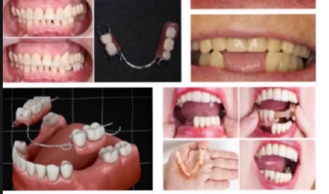 ​«ابتسامتك تستحق الاهتمام.. والعلاج مجاناً بالكامل! 🦷✨»
السلام عليكم جميعاً،
مع بدء العيادات التعليمية، أستقبلكم في العيادة التعليمية لطب وجراحة الفم والأسنان لتقديم أفضل الخدمات الطبية وبأعلى جودة وتحت إشراف كبار الأطباء والأساتذة الاختصاص.
​الخدمات المتوفرة مجاناً:
🔍 فحص وتشخيص أولي كامل للأسنان.
🪥 تنظيف الأسنان وإزالة التكلسات.
🦷 حشوات الأسنان (التجميلية والدائمة).
🦷 قلع الأسنان (حسب الحالة).
🦷 تركيب طقم أسنان (جزئي أو كامل).
💡 تعليمات العناية بصحة الفم والأسنان.
​📍 المكان: العيادة التعليمية - مجمع كليات باب المعظم (كلية أصول الدين).
📞 للحجز والاستفسار: التواصل عبر الخاص أو الرقم التالي (واتساب/اتصال): ***********
​أهلاً وسهلاً بكم دائماً! ❤️

نص مكتوب في الصور:
- ابتسامتك تستحق الاهتمام
- الدكتورة
- THE DOCTOR
- فاطمة قحطان جبر
- الخدمات المتوفرة
- فحص وتشخيص أولي للأسنان
- تنظيف الأسنان وازالة التكلسات
- تعليمات العناية بصحة الفم والأسنان
- حشوات الأسنان
- قلع الأسنان حسب الحالة
- تركيب طقم أسنـان (جزئي أو كامل حسب الحالة)
- العلاج مجاناً
- جميع الإجراءات تحت إشراف دكاترة اختصاص
- للواصل
- ***********
- العيادة التعليمية (مجمع كليات باب معظم) كلية أصول العلم