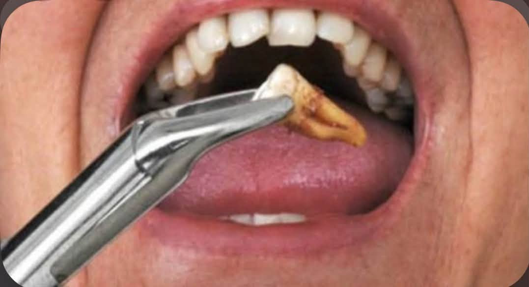 الي محتاج قلع او حشوات او تعويض طقم جزئي او تنظيف اسنان…
الحجز على الخاص او مراسلة الرقم *********** واتساب…(علما ان العلاج مجاني وتحت إشراف اطباء اختصاص)
📌العنوان: بغداد / حي القاهرة / عيادات كلية الرافدين

نص مكتوب في الصور:
- تنظيف الأسنان والتخلص من التكلسات والتصبغات السطحية
- Before After