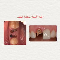 قلع أسنان • بقايا جذور • مجاني