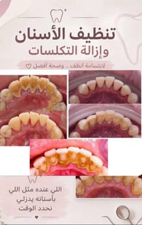 عيادات بيارق العميد • تنظيف أسنان • إزالة تكلسات