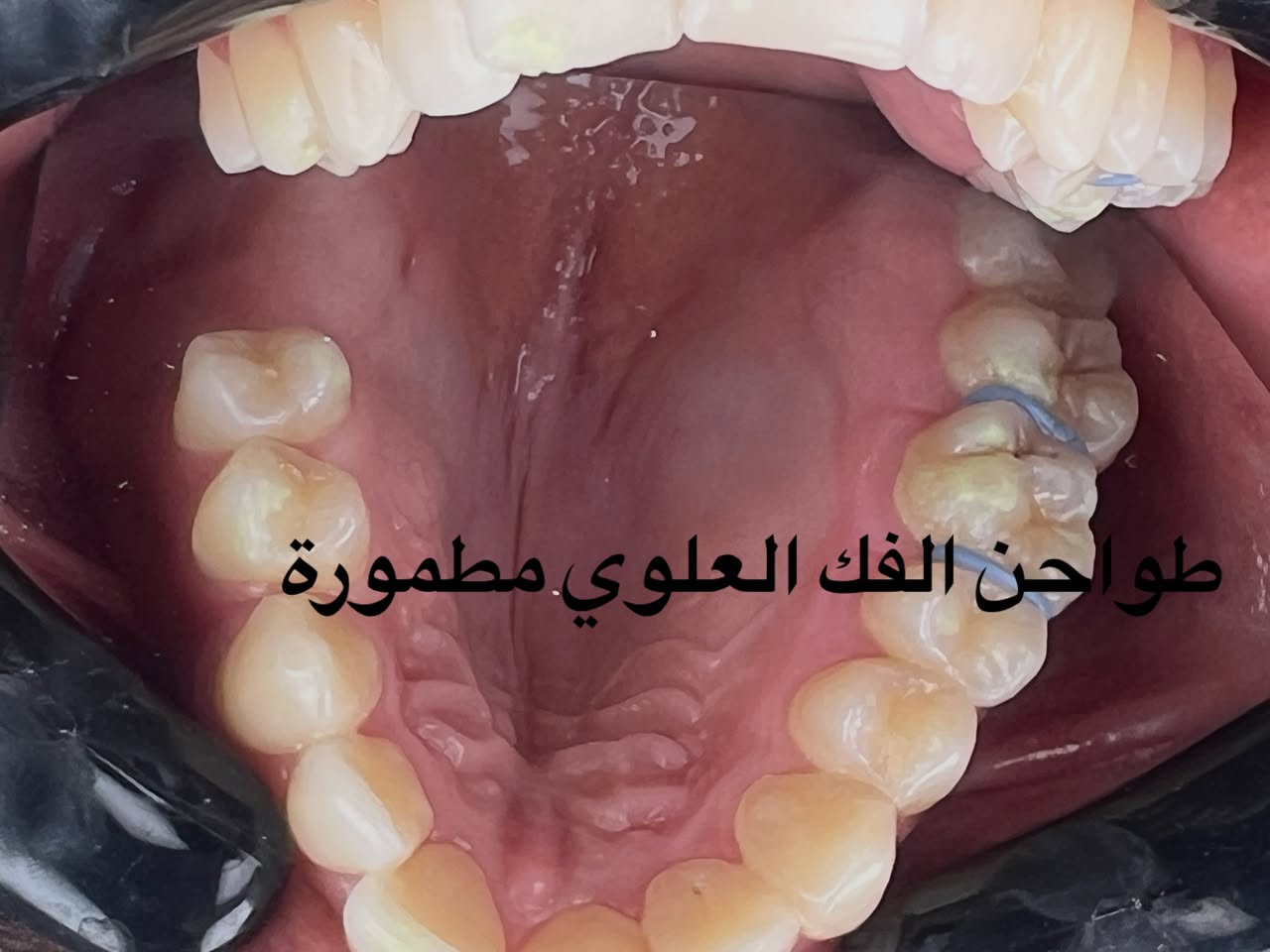التقويم يميزنا احد حالات المعقدة و المستعصية ( الصور تتكلم عن الصعوبة) يعاني من مظهر خارجي غير متناسق غير مرغوب و انزعاجات حادة و صعوبة في تناول الطعام و اثناء الكلام بسبب الاسنان الطواحن الثلاثة في الفك العلوي مطمورة من الحالات النادرة جدا… علاج جميع الحالات الصعبة و المعقدة نتائج مضمونة خبرة طويلة في مجال الحالات المستعصية دقة في إتقان العمل ابتسامة مثالية اسعار مناسبة بالتقسيط المريح…. دكتور غزوان مزهر بغداد الكرخ نفق الشرطة بداية شارع الاطباء عيادة لوركا فوق صيدلية كنز النفق متوفر واتس *********** #تقويم_الاسنان #اطباء_تقويم_الاسنان #العضة_المعكوسة #العضة_المفتوحة #العضة_العميقة @تغليف_الاسنان_الزاركون @حشوات_الاسنان @زراعة_الاسنان @اطباء_تقويم_الاسنان @اطباء_الاسنان

نص مكتوب في الصور:
- ADAM CLINIC - ameer mouhmad التقويم يميزنا عن الصعبة و التحدي أتحدث الأسنان الطواحن الفك العلوي مطمورة
- تقدم الفك السفلي
- انعدم خط المنتصف
- طواحن الفك العلوي مطمورة
- ADAM CLINIC 2025-07-27 - ameer mouhmad طواحن الفك العلوي الثلاث مطمورة