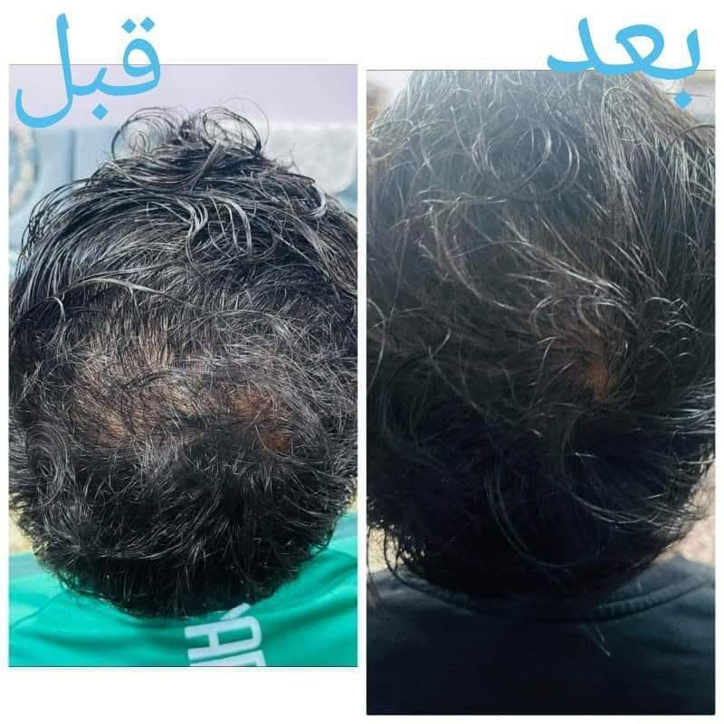 السلام عليكم :
الكتابة
✨ عناية لبشرتك… لأنك تستحق الأفضل ✨
نوفر لكم مجموعة مميزة من منتجات العناية بالبشرة للرجال والنساء 🧴💆‍♀️💆‍♂️
🇮🇷 منتجات إيرانية من شركة لدورة 🌿
💗 منتجات للنساء والرجال
💗 استشارة مجانية لاختيار المنتج المناسب
💗 متابعة الزبون كل أسبوع
💗 متابعة مستمرة وإرشادات لطريقة الاستخدام
📲 متواجدين على الواتساب للاستفسار والطلب:
***********
***********
✨ تواصلوا ويانا، والاستشارة مجانية ✨

نص مكتوب في الصور:
- بعد استعمال بكج التساقط من ماركة لدورا
- قبل بعد
- بشره تعاني من الكلف وحساسيه بالدم بعد استخدام منظف شيرباكون+مصل الكافيار لمدة ١٠ ايام
- بعد استخدام ١٠ ايام من المنتجات
- بعد
- قبل
- بعد استخدام عصاره الليكس