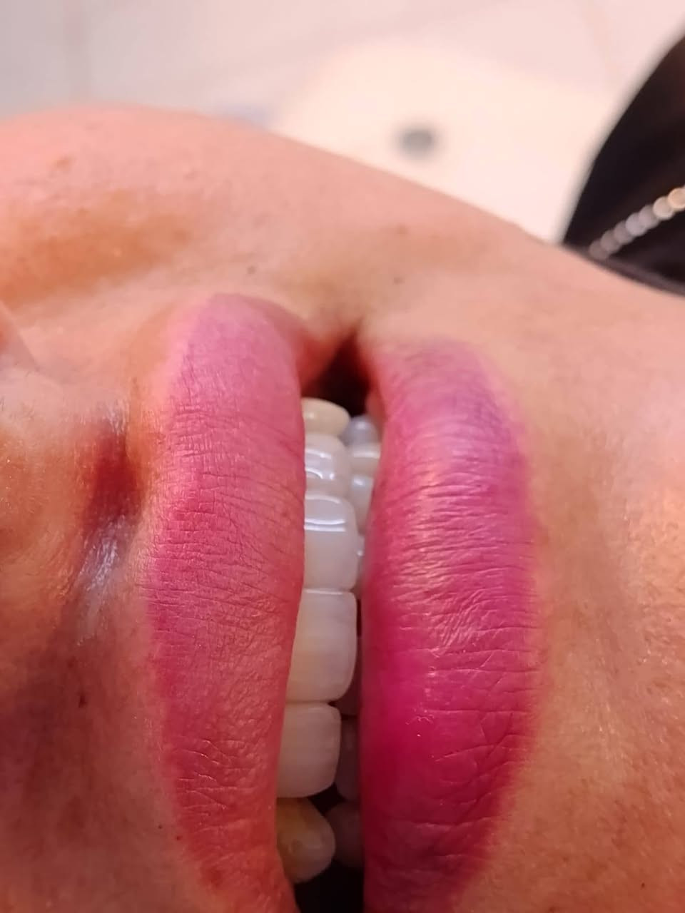 🌟 من اسنان متضرره إلى ابتسامة متكاملة
شغل تخليف وتلبيس بأفضل المواد وبأدق التفاصيل، حتى تكون النتيجة طبيعية ومريحة وتدوم لفترة طويلة.
رضاكم وثقتكم هي نجاحنا. 🦷🤍

الموقع/ حي 17 الشارع العام لمكتبة المهندس مجاور لمدرسة المشاعل

للحجز والاستفسار/ ***********

 متواجدين بلعيادة يومياَ  10صباحاَ لغاية 10مساءاَ
