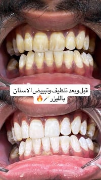 للاستفسار والحجز مراسلة الواتس 07779901922 عيادة كنز الابتسامة نزلة كم...