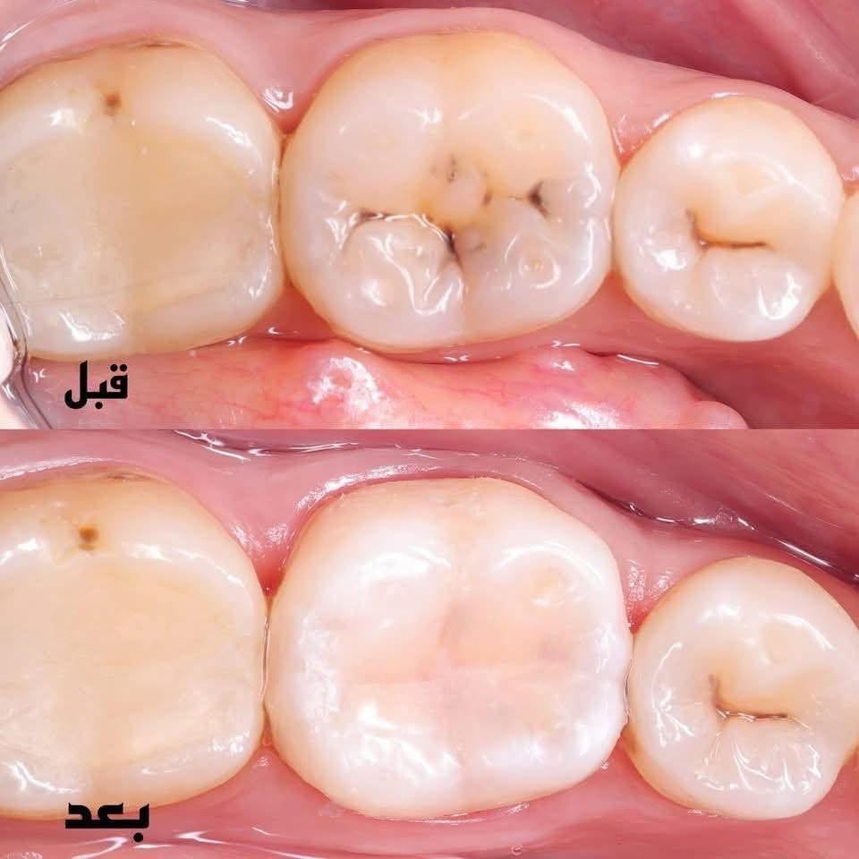 🦷 علاج أسنان مجاني بالكامل
تعلن جامعة ابن سينا للعلوم الطبية والصيدلانية – كلية طب الأسنان عن استقبال المرضى لتقديم عدد من الخدمات والعلاجات السنية مجاناً بالكامل، وذلك بإشراف أطباء اختصاص وكادر طبي متخصص.
📅 موعد بدء استقبال المرضى: 22/9
الخدمات المتوفرة:
• تعويض الأسنان المفقودة بطقم متحرك (كامل أو جزئي)
• الحشوات الضوئية
• قلع الأسنان وبقايا الجذور
• تنظيف الأسنان وإزالة التكلسات والتصبغات
📍 الموقع:
جامعة ابن سينا للعلوم الطبية والصيدلانية – بغداد / القادسية
مقابل محطة وقود البياع، بالقرب من جامعة الفراهيدي.
💙 جميع الخدمات المذكورة مجانية بالكامل، وتُقدَّم بإشراف أطباء اختصاص وكادر طبي.
📞 للاستفسار والحجز:
***********
📱 متوفر واتساب وتليكرام

نص مكتوب في الصور:
- قبل
- بعد
