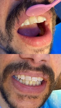 حشوات تجميلية • تنظيف أسنان • مجاني