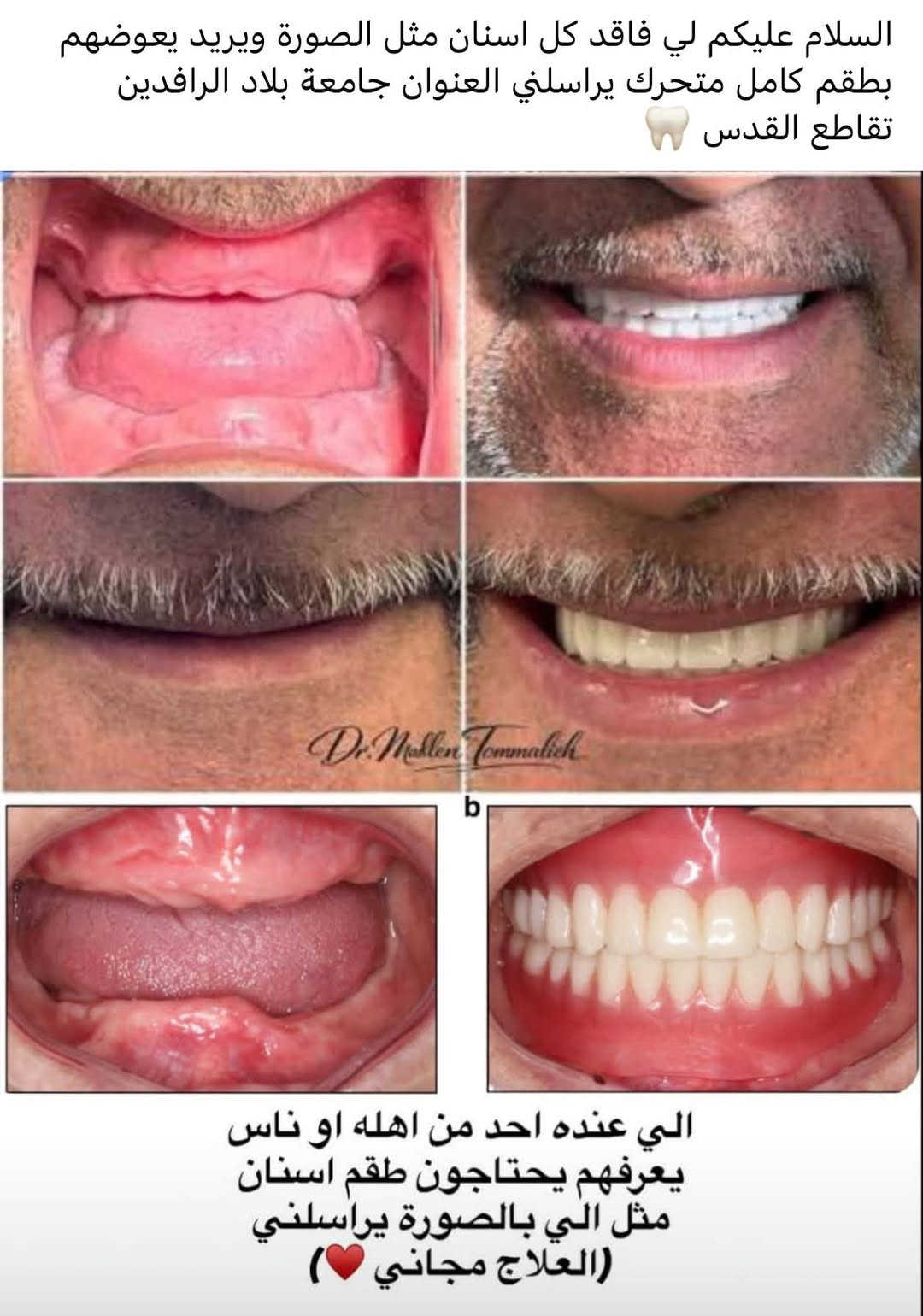 طقم سنان متحرك • مجاني • جامعة بلاد الرافدين