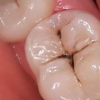 علاج مجاني • تنظيف أسنان • طقم اسنان خلفية