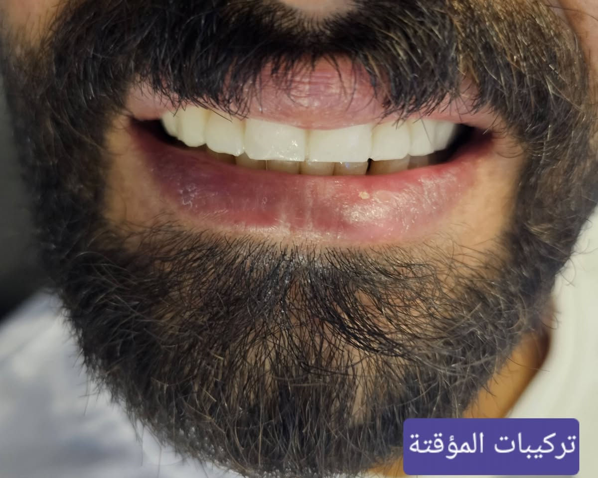 مراجع يعاني من فقدان وعدم انتظام الاسنان ...تم عمل خطة علاجية واكساء الاسنان بتركيبات الزاركون الثابتة ليكتسب ابتسامة رائعة ومشرقة 
د.مريم شاكر محمود 
للحجز ☎️☎️واتس ***********
حي الفارس /الشارع الرئيسي/قرب محطة وقود الفارس /مقابل اسواق جدو🦷🤍
