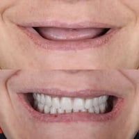 علاج مجاني • طقم أسنان • جامعة الرافدين