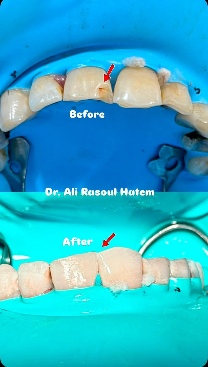 .  نسعى دائماً لتخفيف الالم 
ومساعدتكم في صنع الابتسامه 
 ب اجواد المواد وافضل الطرق التكنيكية 
يكون العمل مجاني 💵
وتحت اشراف اطباء مختصين 👨‍⚕️
للتواصل دايركت. ‪‪@al9ra‬‬ 
واتساب ***********
سنكون بنتظاركم ونعمل معاً لصنع ابتسامة تليق بكم 
زوروا موقعنا. 📍 شارع 40 قرب صيدلية سلامتك ( #عيادات_طب_الأسنان_جامعة_الحله)

سلامة اسنانك جمالك للمستقبل 🤍🦷
.
