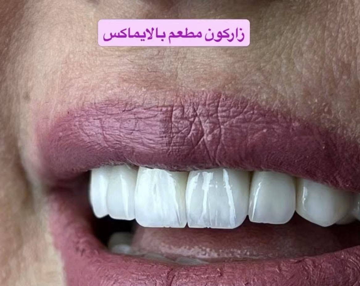 خلي ابتسامتك احلى واجمل مع عيادة ننسوتو😍✨💜
نعالج اسنانكم بجميع انواع الابتسامات :

-الايماكس
-الزاركون المطعم بالايماكس
-الزاركون 7D
-الزاركون الطبيعي

تحت ايادي اطباء مختصين بمجال الابتسامات وبطريقة علمية صحية ..
العنوان :الزعفرانيه اربع شوارع اكبال ابو علي منزليه جنب مركز شاليه للعناية بالسيدات 
يتوفر نظام الاقساط لموضفي ومتقاعدين المصارف (الرشيد ، الرافدين
للاتصال***********او***********

نص مكتوب في الصور:
- E max ایماکس
- زاركون 7D
- زاركون مطعم بالايماكس