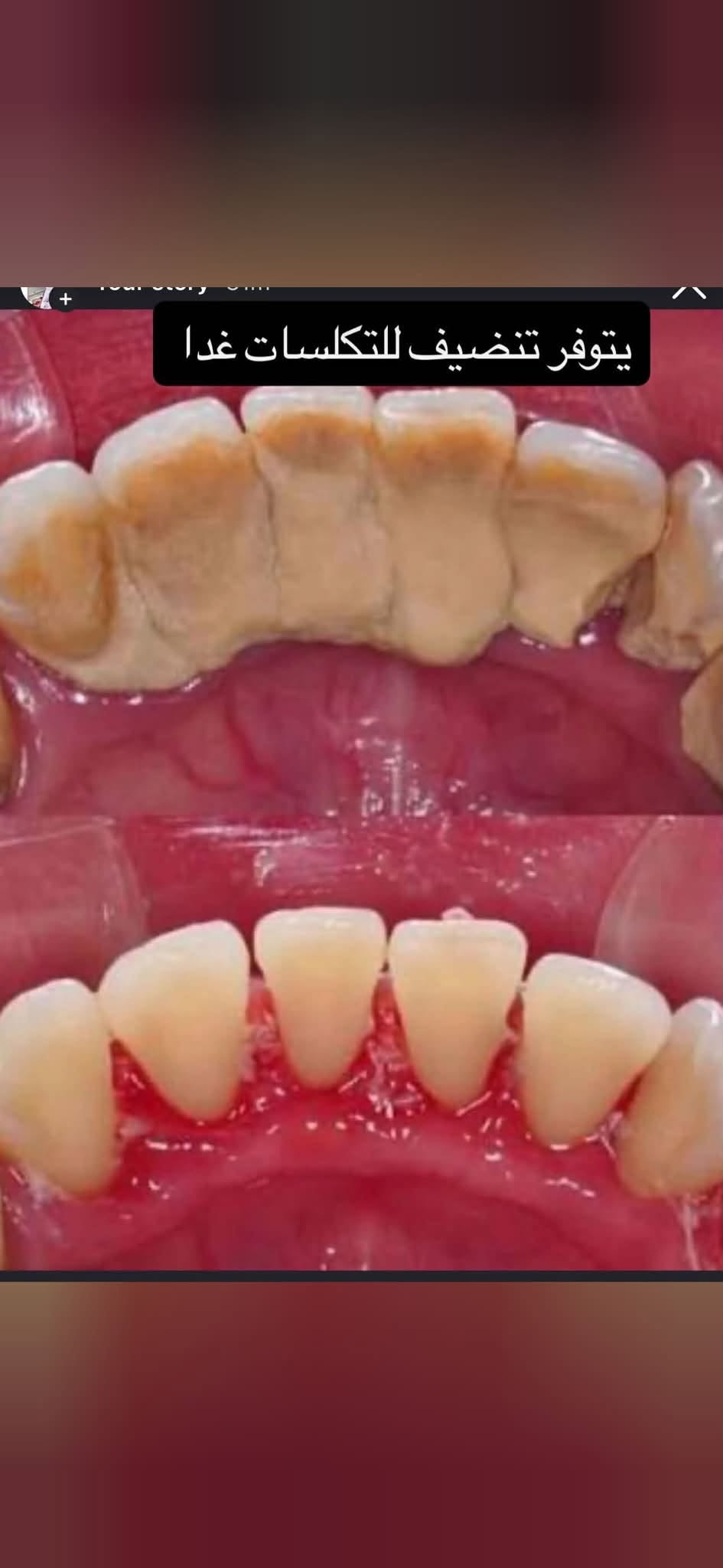 تنظيف تكلسات • تبييض أسنان • جامعة بلاد الرافدين