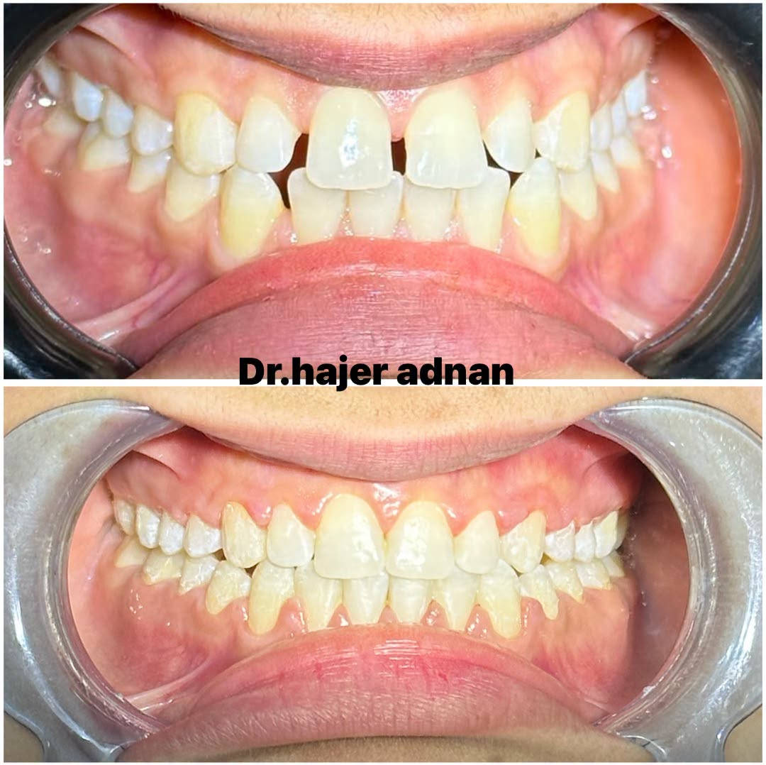 “من فراغات واضحة إلى ابتسامة متناسقة ✨🦷
بعد إكمال علاج التقويم تم إغلاق الفراغات وتحقيق اصطفاف أفضل للأسنان، لتكون النتيجة ابتسامة طبيعية وأكثر جمالًا. 🤍 
الدكتورة هاجر عدنان

نص مكتوب في الصور:
- Dr.hajer adnan