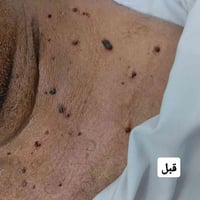 إزالة زوائد جلدية • جهاز الكوي • سوق الشيوخ