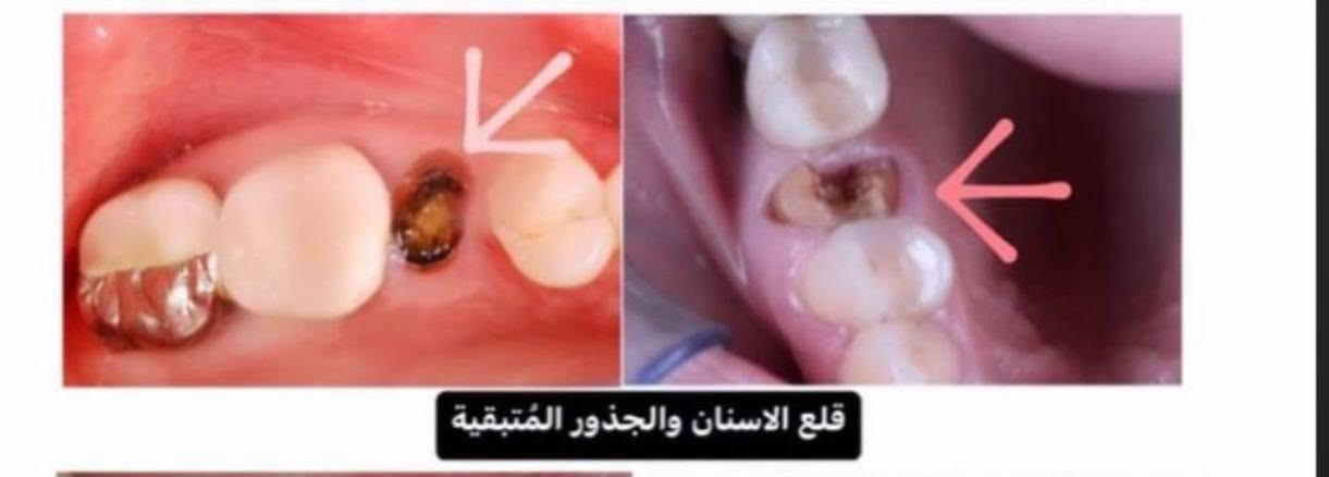 سلام عليكم ورحمة الله وبركاته
تتوفر  حالات قلع الأسنان والجذور المتبقية في العيادات التعليمية – كلية طب الأسنان / جامعة الموصل.
✨ الأجور متكفّل بها .
📞 للراغبين بالتواصل والاستفسار: [***********]
