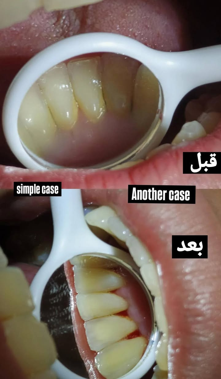 تنظيف اسنان • طقم متحرك • قلع جذور