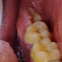 مستشفى جامعة البيان • علاج مجاني • زراعة أسنان