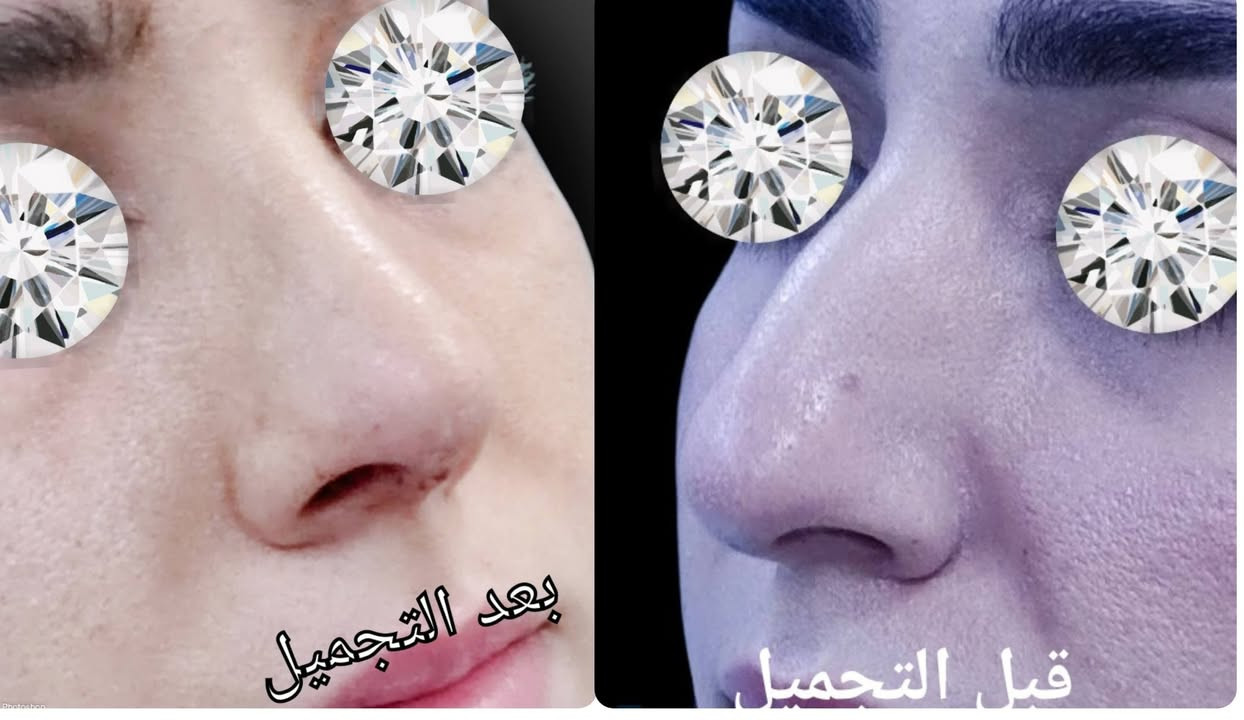 Natural Rhinoplasty
Alyasiery clinic for Rhinoplasty
***********
