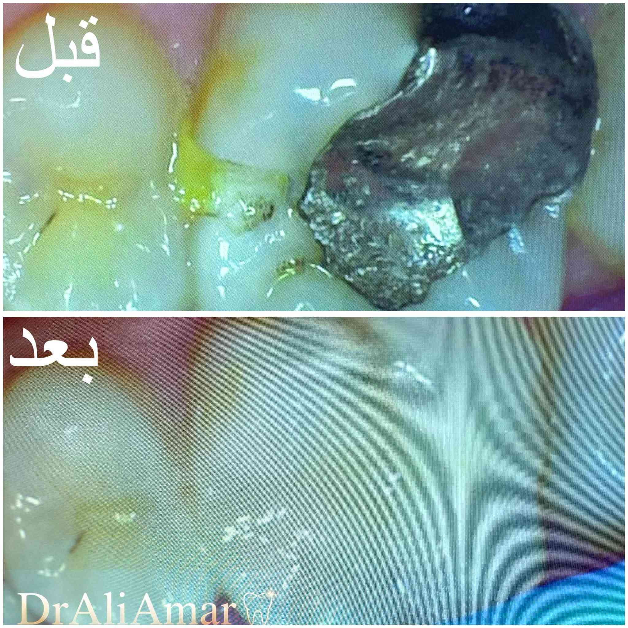 🦷 حشوتك القديمة ممكن تكون سبب الألم… وانت ما تدري!

هذا المراجع وصلنا بـ ألم قوي، وبعد الفحص والأشعة اكتشفنا تسوس ثاني تحت الحشوة المعدنية القديمة.

تمت إزالة الحشوة والتسوس، وترميم السن بـ حشوة ضوئية مع استعادة شكله ووظيفته ✨

⚠️ إذا عندك حشوة قديمة أو تحس بألم بالسن، لا تنتظر المشكلة تكبر.

📲 احجز موعدك هسه بعيادة فَيّ
وخلي نبدأ بفحص دقيق ونحدد العلاج المناسب إلك.

📩 راسلنا على الخاص للحجز.
@***********

نص مكتوب في الصور:
- قبل
- بعد
- DrAliAmar
- DrAli Amar