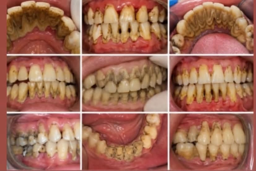 عيادات مجانية • اسنان اطفال • قلع اسنان
