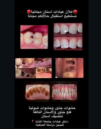 مجاني • جامعة المنارة • قلع أسنان