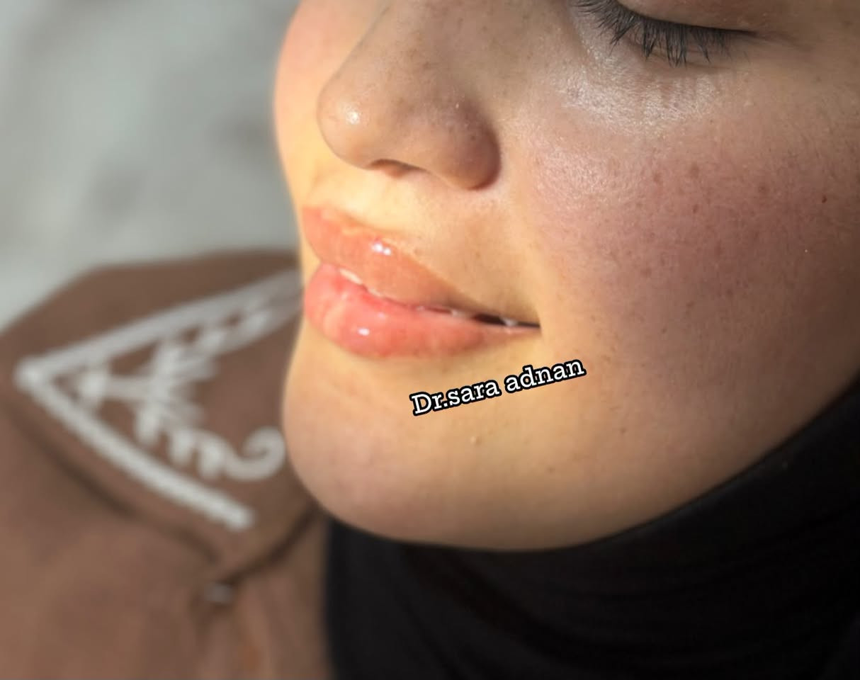 ✨ شفاه أكثر امتلاءً وتناسقًا بإطلالة طبيعية تبرز جمالكِ وثقتكِ بنفسكِ
💉 بإشراف د. ساره عدنان

#فلر_الشفاه #شفاه_ممتلئة #تجميل #جمال #عناية_بالبشرة #نتائج_طبيعية #د_ساره_عدنان #Beauty #LipFiller #AestheticMedicine

نص مكتوب في الصور:
- Dr.sara adnan