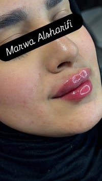 فيلر شفة • مروة الشريفي • حجز دايركت