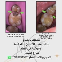 🦷 فرصة علاج الأسنان في عيادات الجامعة الأمريكية في بغداد العلاج يتم تح...