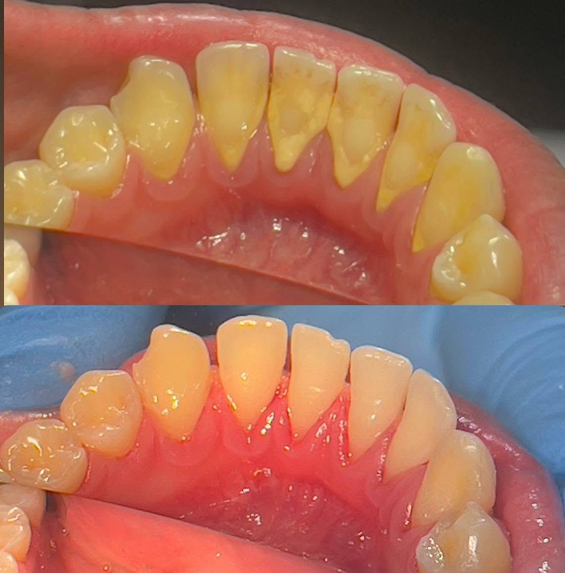 🦷✨ علاج أسنان مجاني وتحت إشراف أطباء اختصاص ✨🦷

إذا عندك مشكلة بأسنانك ومأجل علاجها، هاي فرصتك 🤍

أوفر لكم علاج وفحوصات أسنان مجاناً ضمن العيادات التعليمية، وبإشراف مباشر من أطباء أسنان اختصاص 👨‍⚕️🦷

🔹 تنظيف الأسنان وإزالة التكلسات
🔹 الحشوات ومعالجة التسوس
🔹 قلع الأسنان عند الحاجة
🔹 صناعة وتركيبات الأسنان
🔹 فحص وتشخيص ومتابعة الحالة
اذا عندك حالة كهذه راح نعالجها بل جامعة و تحت إشراف أطباء اختصاص 

📍 عيادات طب الأسنان – جامعة المستقبل
📍 سريع – حلة – نجف

💯 العلاج مجاني
👨‍⚕️ تحت إشراف أطباء اختصاص
🦷 الاهتمام بالحالة خطوة بخطوة

📩 إذا مهتم أو تعرف شخص يحتاج علاج، راسلني خاص او على الرقم واتساب *********** حتى ننسق الموعد.
