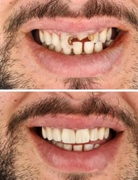 عيادة اسنان • الفاو • زراعة اسنان