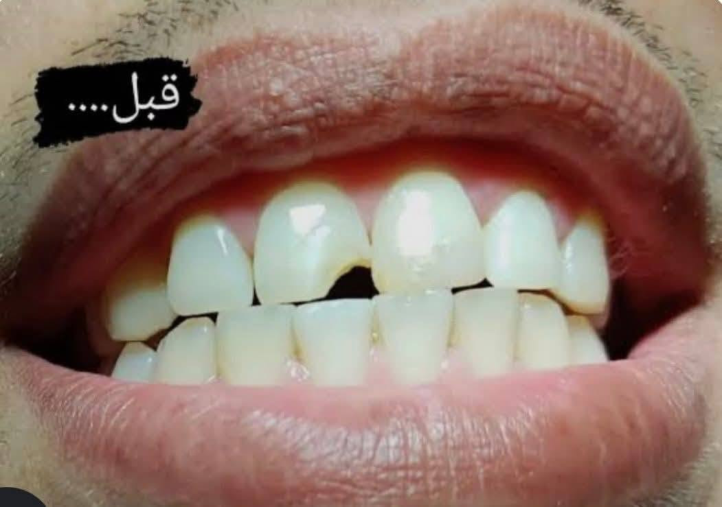 هلاو شباب اللي عدة هالحالات او احد من اهلة خلي يتواصل ويايه خاص للعلاج مجاناً
(تسوس او كسر الاسنان الامامية والخلفية ،قلع بقايا جذور او اسنان تالفة ، قلع سن العقل ، تنظييف الاسنان وازالة التكلسات٫ فحص اسنان الاطفال وعلاجها )
علماً ان الحشوات المستخدمة هي حشوات ضوئية بلون السن
العنوان شارع فلسطين 
***********

نص مكتوب في الصور:
- HONOR 400
- قبل....
- The image may have been resized.