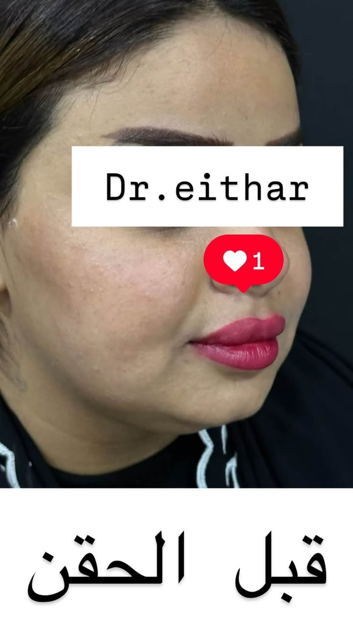 كونتور الوجه بالفلر  (لفتنك وجنات وتدوير الفك والذقن ونظاره) 🔥🔥
لاحضو الفرق بالذقن ومنطقه الفك شكد تغير الشكل🔥
عروووض فرحة الزهره ثبتتهه الكم بالستوري بالهايلايت وببوست اعلى الصفحة ✨✨

د.ايثار سامي عبد الامير
واسط الكوت الهوره مجمع القبطان طابق اول 

الحجز***********
