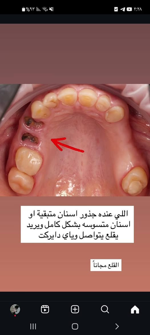 السلام عليكم 
الي محتاج قلع ، حشوات ، تنظيف بأحدث الاجهزة ، اطقم اسنان كاملة ، وعلاج كامل للأطفال(قلع ، حشوات،  حشوات جذور ، تقويم ، جلسات فلورايد )
العلاج مجانا بالكامل تحت إشراف اطباء اختصاص 
للتواصل والاستفسار 9647753272241

نص مكتوب في الصور:
- (يريو)
- هذولي حالات التنظيف الي عنده هيج تكلسات أو يعرف احد عنده هيج تكلسات او عنده اسنانه يريد يفحص اذا يحتاجن تنظيف او لا يراسلني♡.
- (الاوبرثف)
- هذولي حالات الحشوات الي عنده
- هيج حالة يراسلني🤍.
- و العلاج مجاني وتحت اشراف طبي
- رفل جاسم
- ٢٠٢٥/١٠/١٦
- @doctorgorlanov
- اللي عنده جذور اسنان متبقية او اسنان متسوسه بشكل كامل ويريد يقلع يتواصل وياي دايركت القلع مجاناً