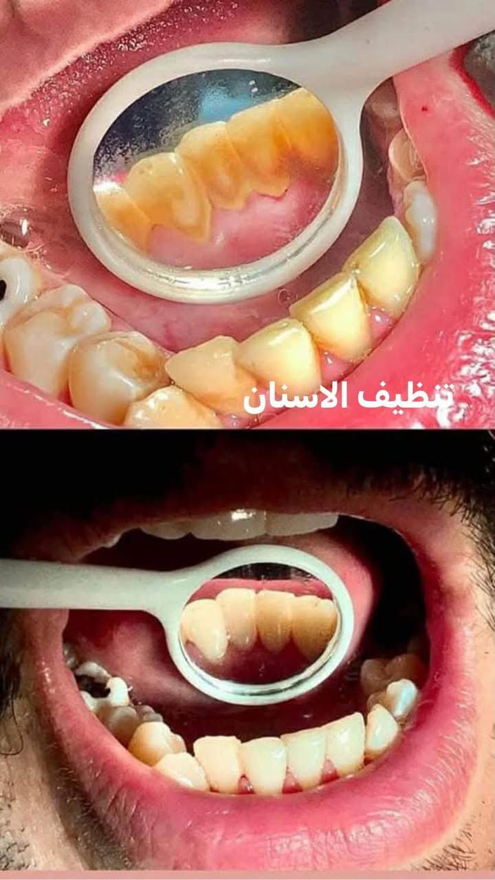 اللي يريد يحجز يتصل او يدز عالخاص
عيادة طب الاسنان 
تقويم الاسنان ،، زراعة الاسنان ،، حشوات تجميلية
تركيب الاسنان (سيراميك و زارگون)،، حشوات جذور ،، قلع،، حشوات مؤقتة ودائمية ،، تنظيف وتلميع الاسنان ،، تبييض الاسنان بالليزر 
متواجدين طيلة أيام الاسبوع 
للحجز والاستفسار ع الخاص او ع الرقم 
*********** واتساب 
العنوان .. الامين الثانية شارع البنازيخانة يم السوگ 
قریب ع افران السلام واسواق الشارقة مقابل محلات الصبيحاوي
مجمع دكتورة رجاء محمد نصيري
