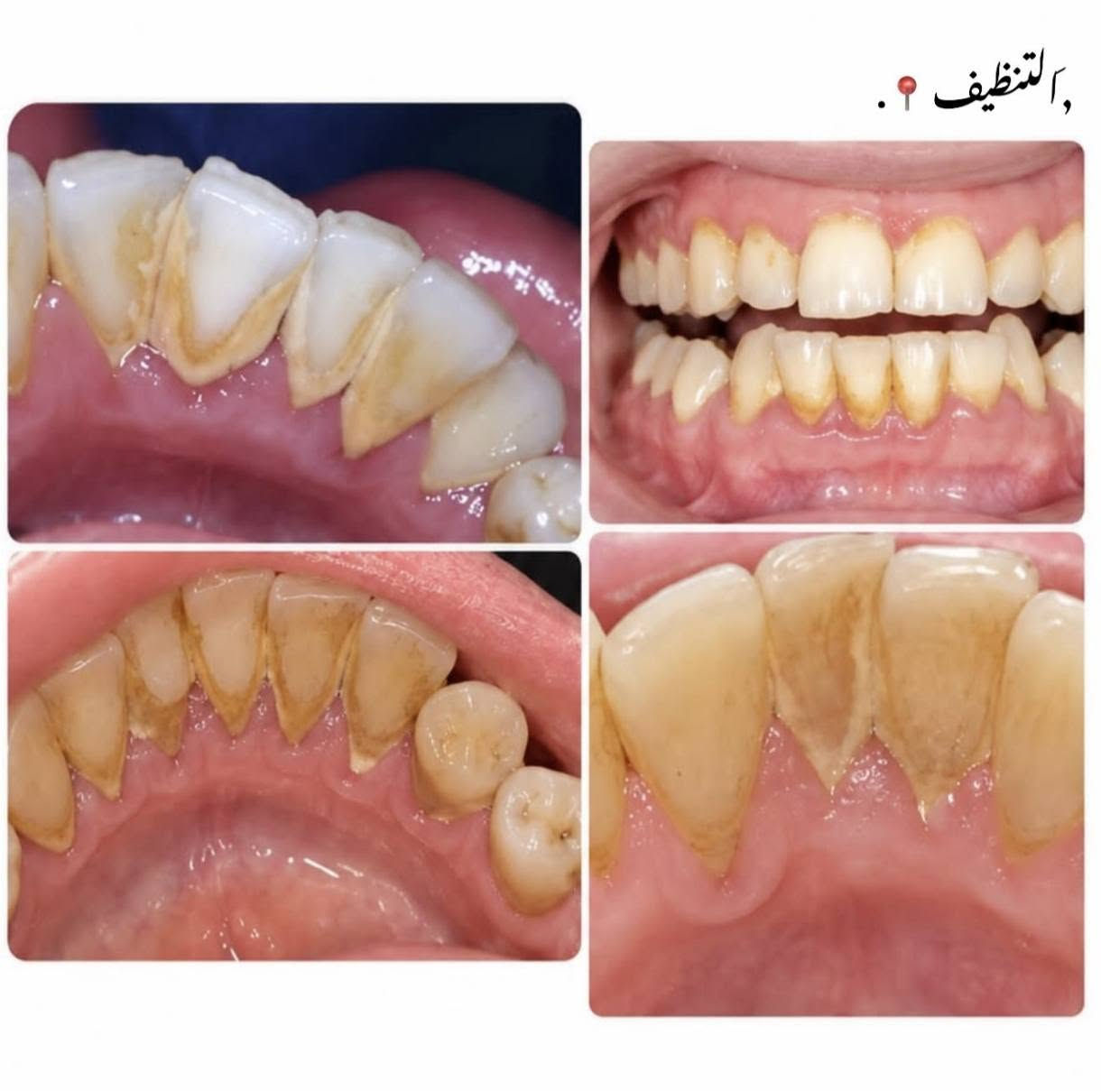 علاج مجاني بالكامل
السلام عليكم اي شخص عنده حالة من الحالات نكدر نعالج اسنانه بشكل مجاني بالكامل 
واتساب ***********

نص مكتوب في الصور:
- مجاناً
- التنظيف؟.
- التسوس 📍 .
- حالات اخرى .
- القلع 📍 .