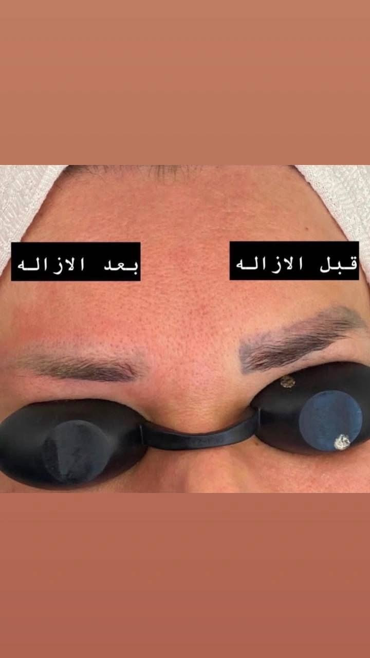 ✨ تألقي بجمال طبيعي وبشرة ساحرة! ✨
تعلـن عيـادة الدكتـورة إينـاس محمـد (اختصاص تجميل وليزر) عن تقديم أحدث الخدمات التجميلية والعلاجية بأحدث التقنيات العالمية لضمان أفضل النتائج وأكثرها أماناً.
خدماتنا المميزة:
 جلسات الليزر: إزالة الشعر بأحدث أجهزة الليزر البارد، وتوريد الشفاه، وإزالة التصبغات.
 الحقن التجميلي: بوتوكس لشد التجاعيد، وفيلر لنضارة وتعبئة الوجه، وإبر النضارة (الميزوثيرابي والبلازما).
 العناية بالبشرة: هيدرافشيال متكامل، تقشير كيميائي وبارد، وعلاج آثار الشباب والتمدد.
 .📍  العنوان: [حي العدل شارع الاسواق /مجاور لحوم رسول العنبر]
📞 للحجز والاستفسار: [***********]
📲 تواصلوا معنا عبر الواتساب: [***********]
جمالكِ يستحق الرعاية الأفضل.. بانتظار زيارتكِ!
