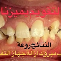 تقويم الأسنان • حالات معقدة • فحص مجاني