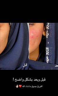 فلر إيطالي • ملء الخسفات • دكتورة هبة